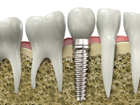 Dental Implants Upland