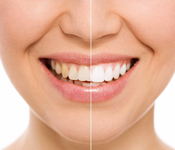 whitening.jpg