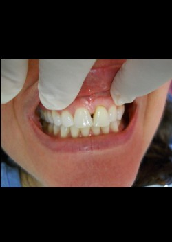 Before Image: Crown Case #1328 - front
