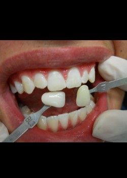 After Image: Zoom Whitening Case #1333 - front