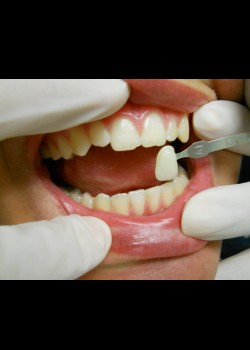 Before Image: Zoom Whitening Case #1333 - front