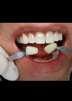 After Image: Zoom Whitening Case #1338 - front