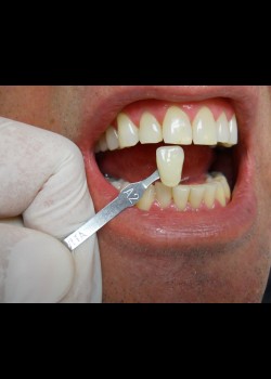 Before Image: Zoom Whitening Case #1338 - front