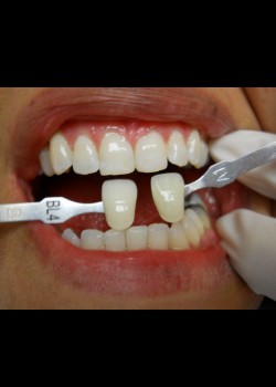 After Image: Zoom Whitening Case #1342 - front