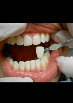 Before Image: Zoom Whitening Case #1342 - front