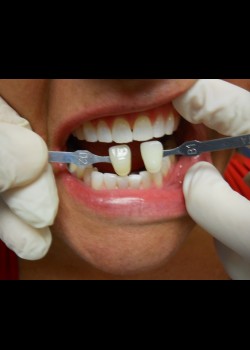 After Image: Zoom Whitening Case #1345 - front