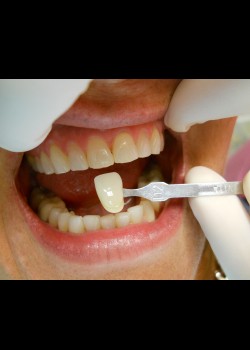 Before Image: Zoom Whitening Case #1345 - front