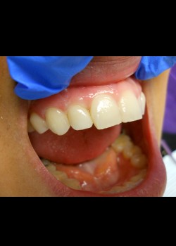 After Image: Crown Case #1391 - front