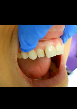 Before Image: Crown Case #1391 - front
