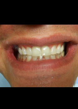 After Image: Crown Case #1392 - front