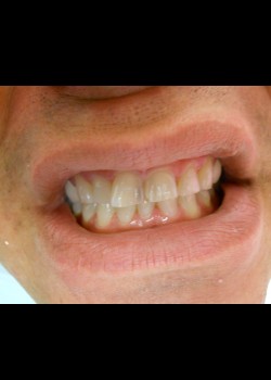Before Image: Crown Case #1392 - front