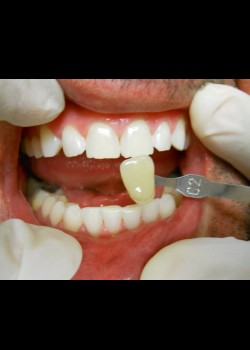 After Image: Zoom Whitening Case #1393 - front