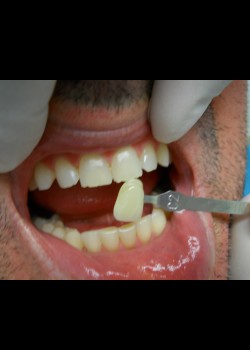 Before Image: Zoom Whitening Case #1393 - front