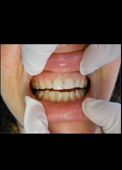 After Image: Crown Case #0406 - front