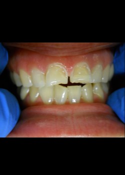 Before Image: Crown Case #0406 - front