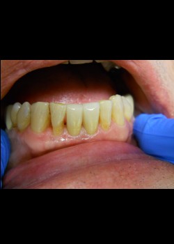 After Image: Crown Case #0414 - front