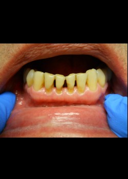 Before Image: Crown Case #0414 - front