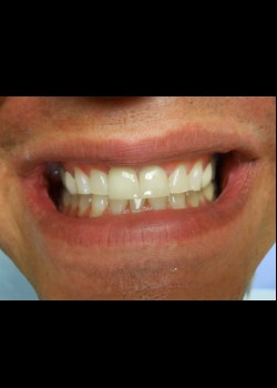 After Image: Crown Case #0414 - front