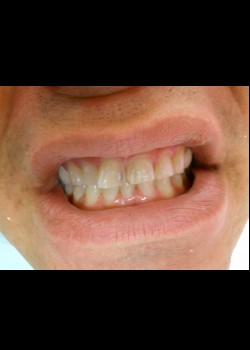 Before Image: Crown Case #0414 - front